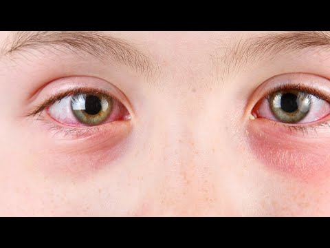 Mayo Clinic Minute – What is pink eye? [Video]