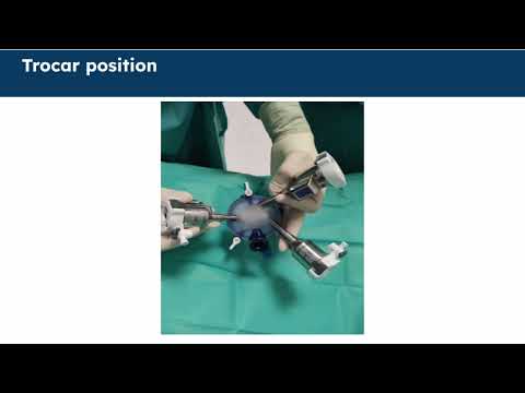 Robotic Transanal Minimally Invasive Surgery (R-TAMIS) for the regrowth of rectal cancer [Video]