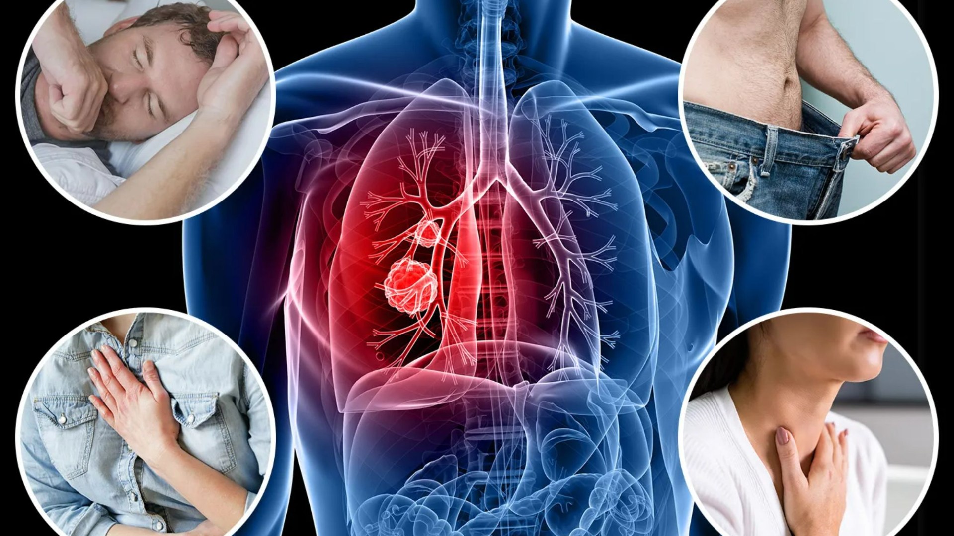 The 12 lung cancer symptoms commonly found in patients who have never smoked [Video]