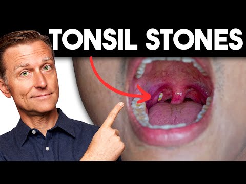 Tonsil Stones: Removing the Deeper Cause [Video]