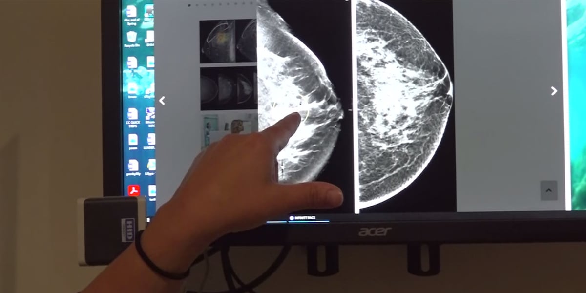 CDC: Costs, social isolation keep women from getting mammograms [Video]