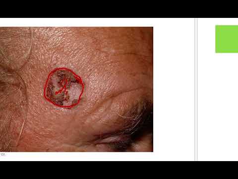 skin cancer MRCS question solve (CRACK MRCS) [Video]