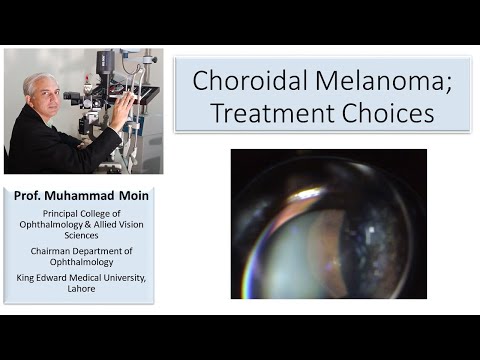Choroidal Melanoma; Treatment Choices [Video]