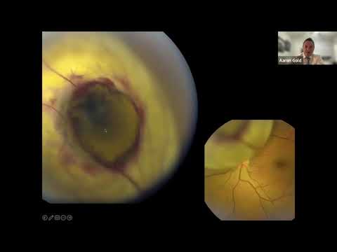 Dissecting Malignant Intraocular Lesions: From Diagnosis to Management [Video]