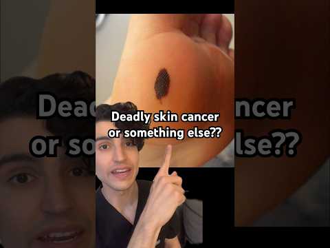 Dark spot on foot: deadly skin cancer or something else? [Video]