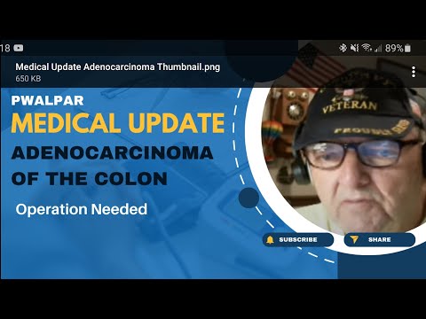 Adenocarcinoma of the Colon Pwalpar Medical Update [Video]