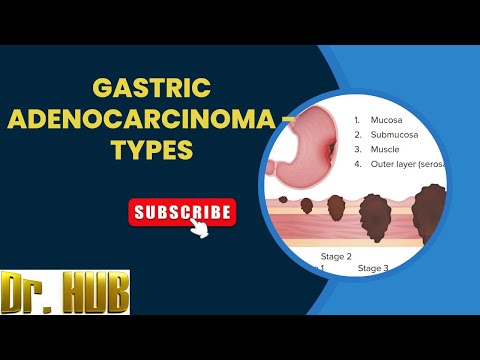 Gastric adenocarcinoma – Types [Video]