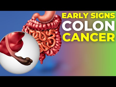 The Early Signs of Colon Cancer You DON’T Want to Ignore [Video]