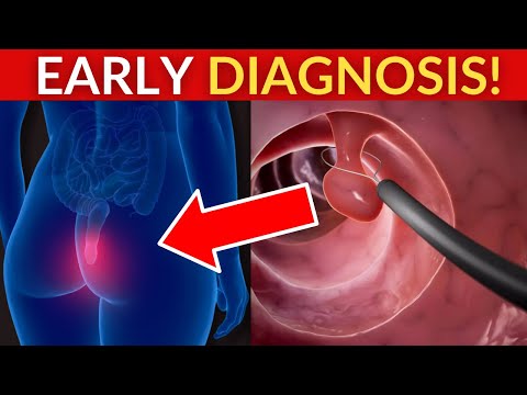 Early Critical Symptoms of Colon Cancer That Should Not Be Ignored [Video]