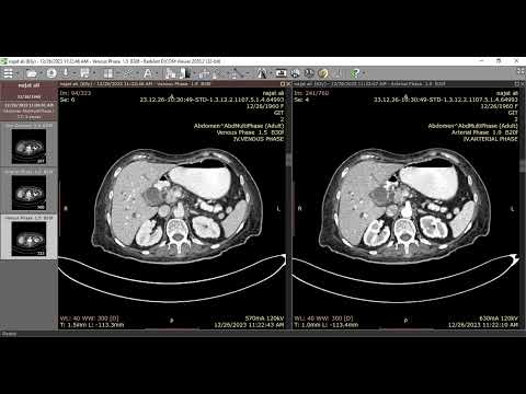 Adenocarcinoma of the pancreatic head [Video]