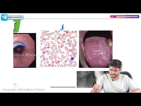 7. Esophageal Tumours ( Benign and Malignant ) :USMLE Step 1 Pathology [Video]