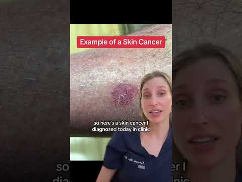 Sharing examples of skin cancer so you can have an informed idea of what to look for in self exams. [Video]