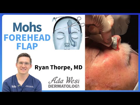 Skin cancer on the nose: Mohs repair using forehead flap [Video]