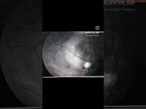 Young Male patient with right Choroidal Melanoma. [Video]