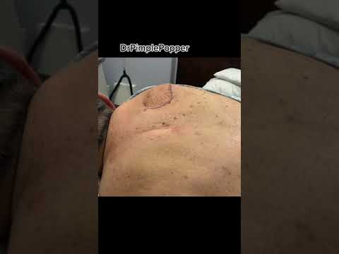 A Perfect Lipoma Technique! [Video]