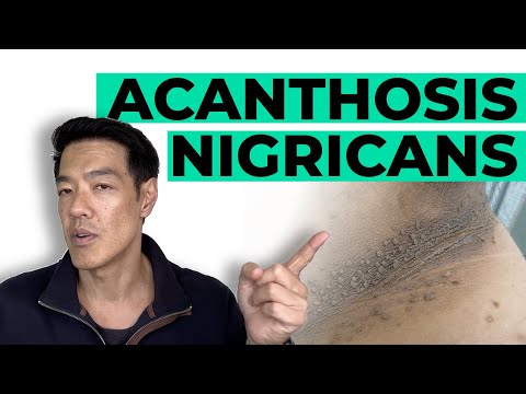 How to treat Acanthosis Nigricans | Dr Davin Lim [Video]