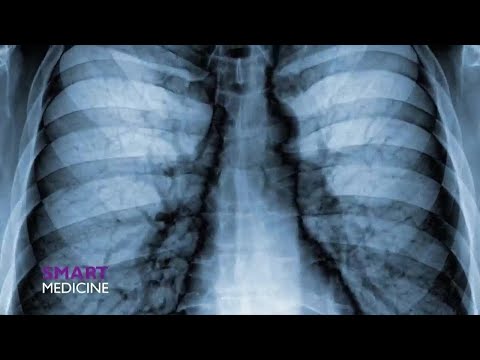 Smart Medicine – Lung Cancer in Cenla [Video]