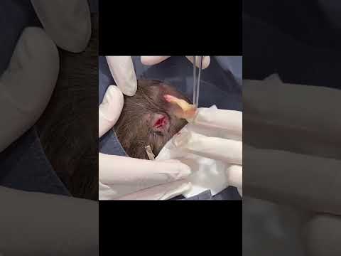 Out of THIS WORLD Pilar Cyst [Video]