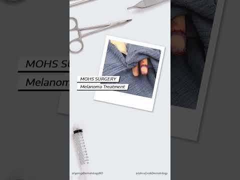 Mohs Surgery for Melanoma [Video]
