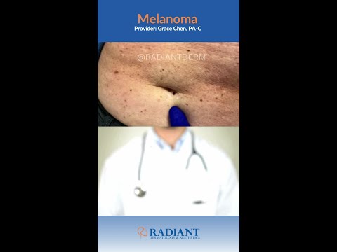 What is melanoma? [Video]