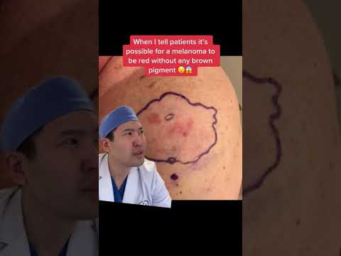 Did you know that Melanomas can be Red? [Video]