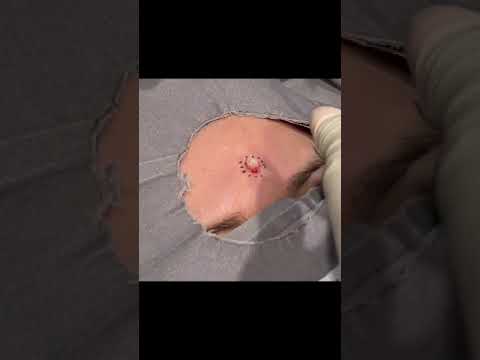 Third Eye Removal [Video]
