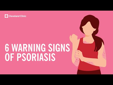 6 Warning Signs of Psoriasis [Video]