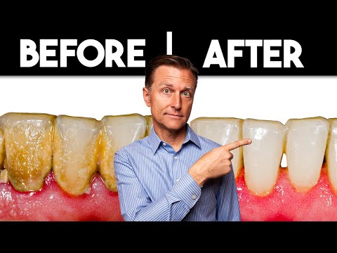 Preventing Dental Plaque Formation Forever: Simple Solution [Video]