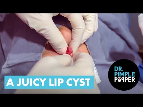 A JUICY LIP CYST [Video]