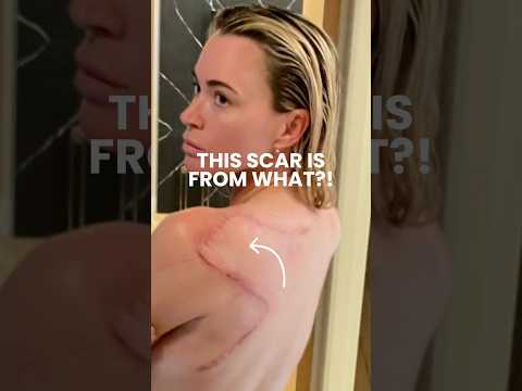 This scar is from WHAT?! 😱 [Video]