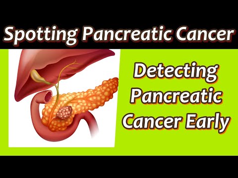 10 Vital Symptoms of Pancreatic Cancer Not to Ignore | Detecting Pancreatic Cancer Early [Video]