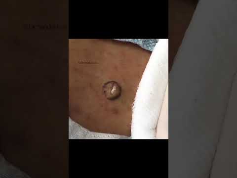 Cyst on Top [Video]
