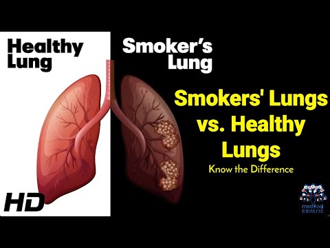 Smokers vs. Non-Smokers: A Lung Comparison You Need to See [Video]