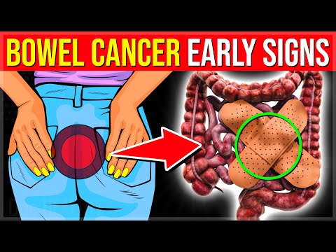 10 Early Warning Signs Of BOWEL CANCER You Should Not Ignore – (Colon Cancer Signs) [Video]