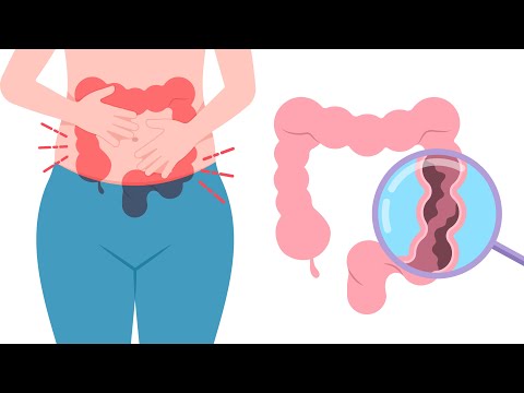 10 Warning Signs Of Colorectal Cancer You Shouldn’t Ignore | Natural Health Forever [Video]