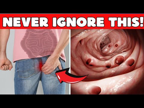 Early Warning Signs Of Colon Cancer You Should Never Ignore [Video]