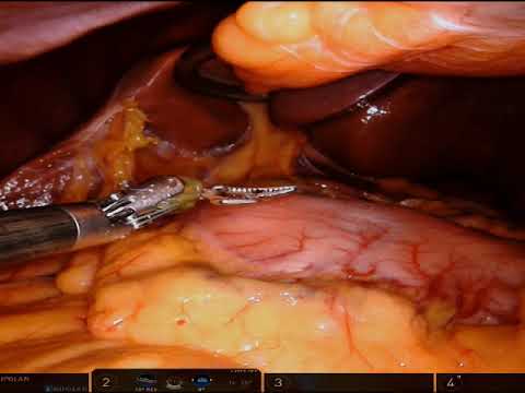 Distal gastrectomy/D2 lymphadenectomy for early pyloric gastric adenocarcinoma. Unedited, 4x speed [Video]