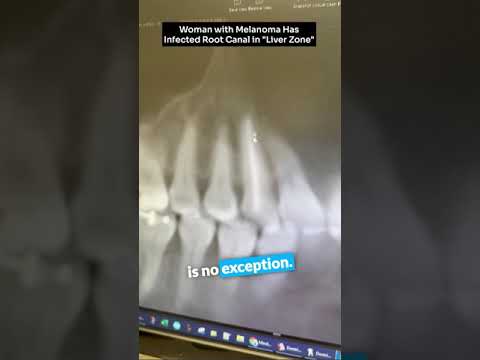 Woman with melanoma has infected root canal in “liver zone” [Video]