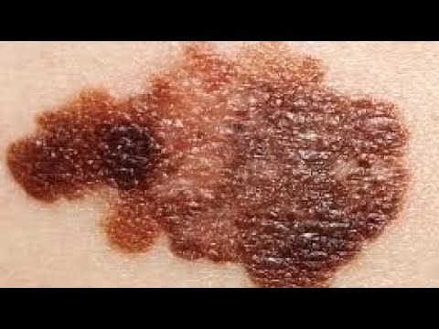 what is malignant melanoma?😱😱OMG [Video]