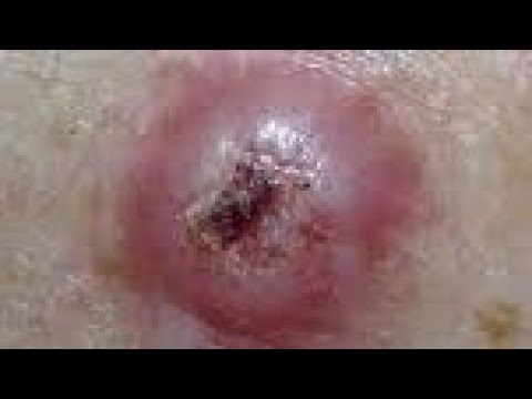 what is squamous cell carcinoma?😱😱OMG [Video]