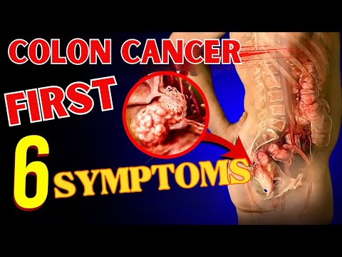 first 6 symptoms of colon cancer [Video]