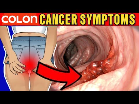 Unlocking the Secrets: Recognizing Colon Cancer Symptoms Before It’s Too Late! [Video]