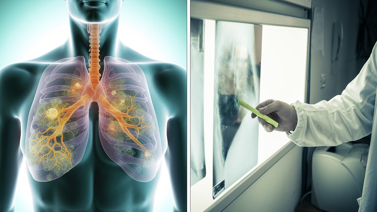 10 Silent Symptoms of Lung Cancer to Never Ignore [Video]