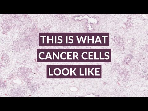 Cancer vs Non-Cancer Cells | Mucinous Lung Adenocarcinoma [Video]