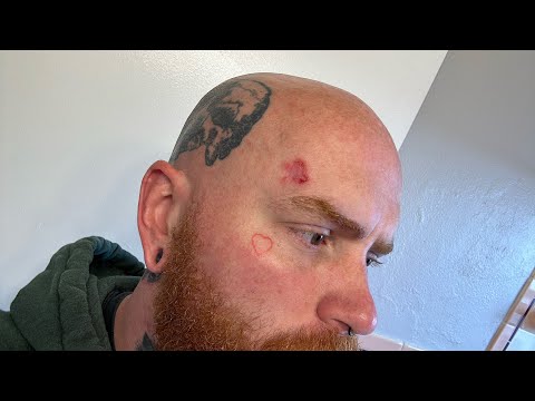 End Of Week 1 Superficial Basal Cell Carcinoma (Skin Cancer) Aldara Cream Treatment [Video]