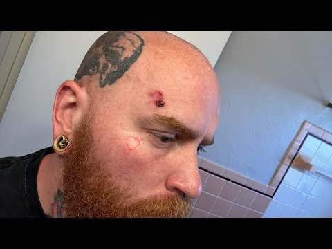 Week 2 Superficial Basal Cell Carcinoma (Skin Cancer) Aldara Treatment [Video]