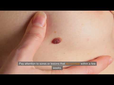 Detecting Skin Cancer – Early Signs and Symptoms to Look For [Video]