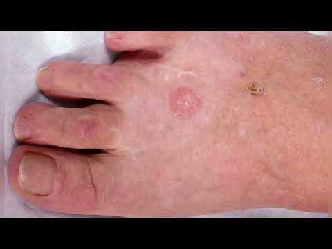 Basal cell Carcinoma ( BCC ) [Video]