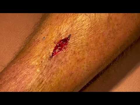 Mohs surgery for suamous cell carcinoma [Video]