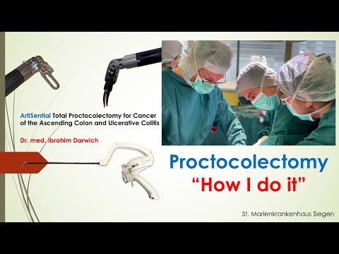#ArtiSential assisted total proctocolectomy for Colon Cancer and Ulcerative Colitis [Video]